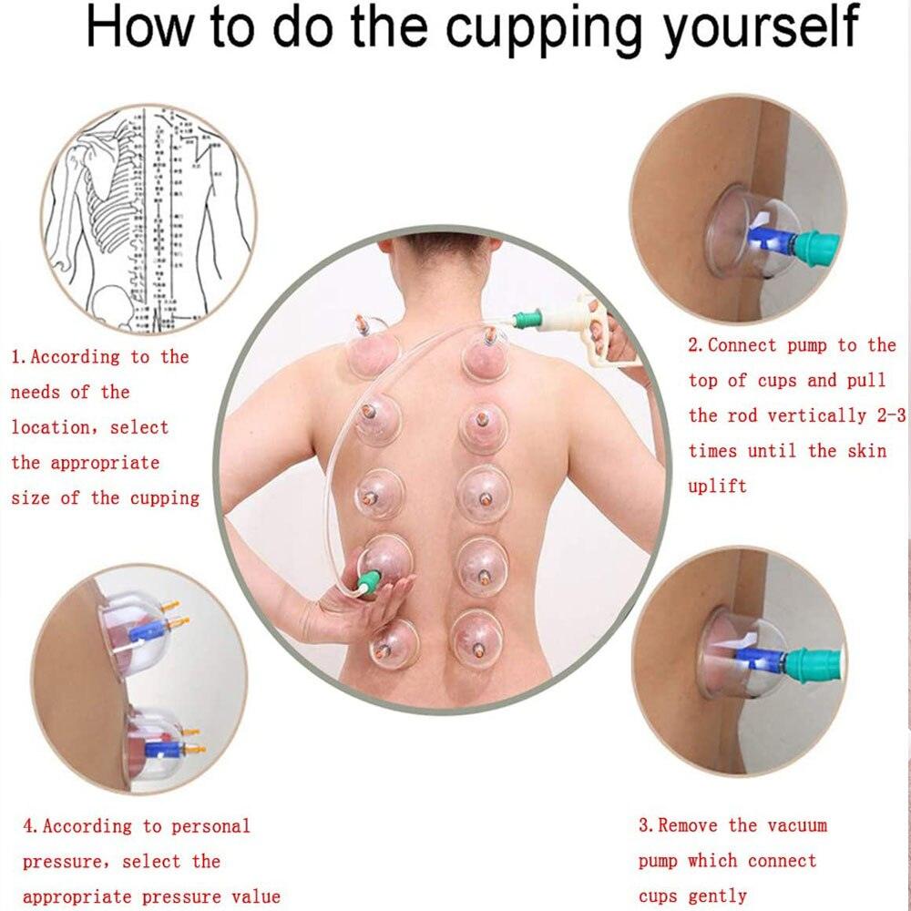 Ensemble de Thérapie CUPPING Tasses Ventouse chinoises Confort Orthopédique