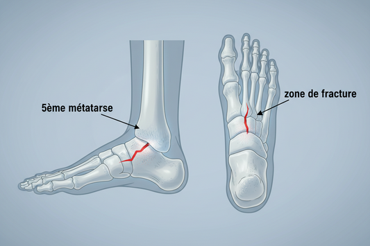 Guide Complet sur le Temps de Consolidation de la Fracture du 5ème Métatarse