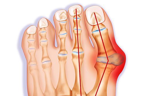 Sandales pour oignons : soulager la douleur des oignons sans chirurgie | Confort Orthopédiques